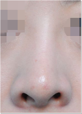 코재수술 전후사진